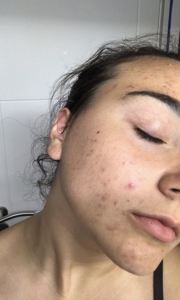 photo acné Lucie cesari avant traitement clear skin